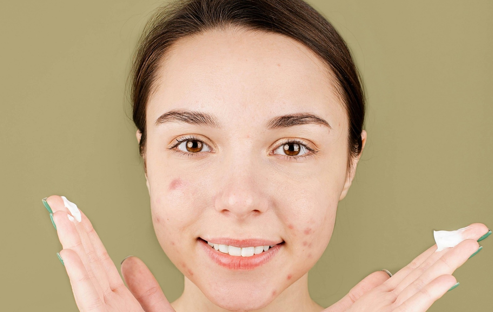 Dieta care te scapa de acnee