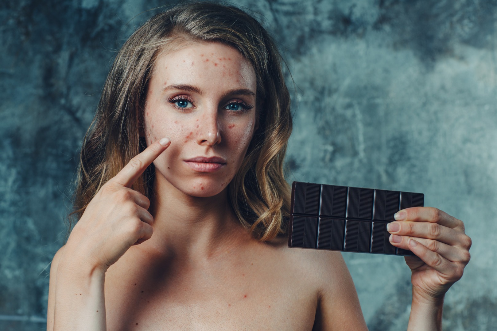 Dulciurile cauzează acnee